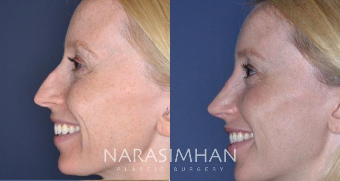 Before & After Rhinoplasty Case 167 View #1 View in Tampa, Florida