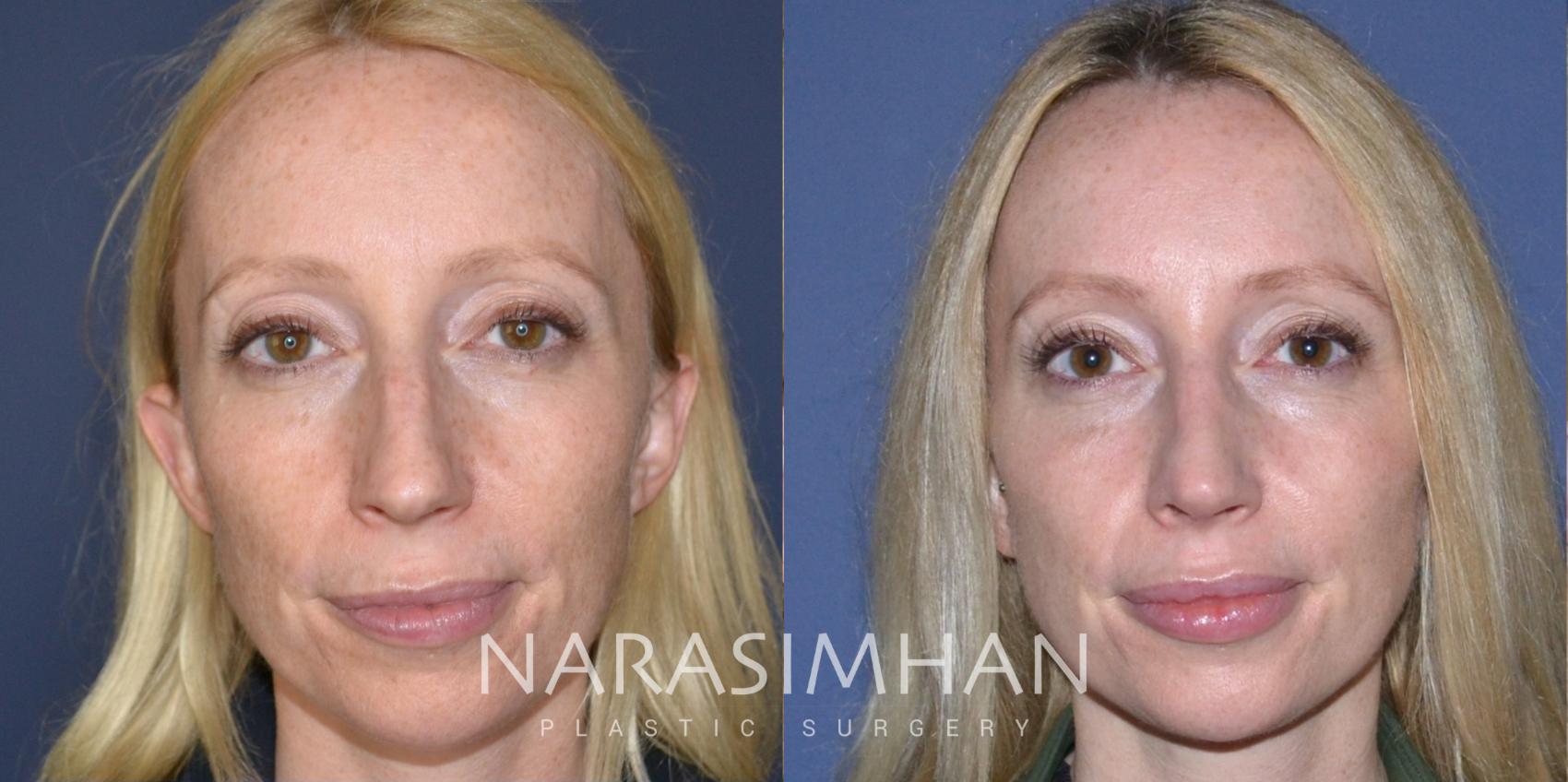 Before & After Rhinoplasty Case 167 View #2 View in St Petersburg, Florida