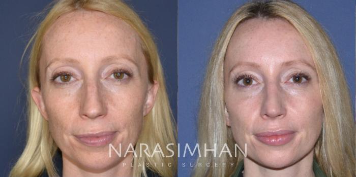 Before & After Rhinoplasty Case 167 View #2 View in Tampa, Florida