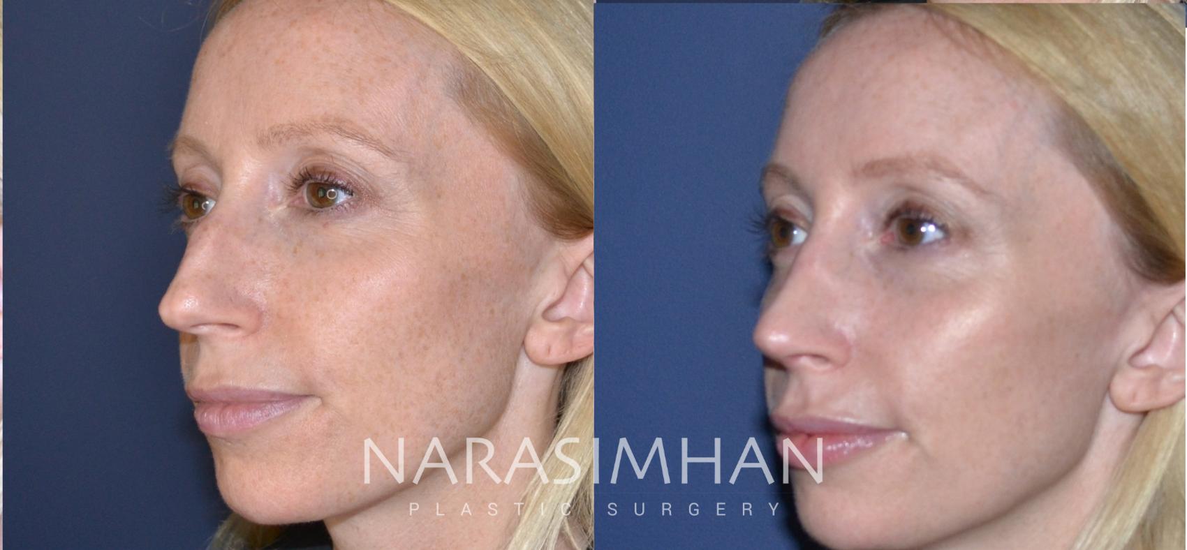 Before & After Rhinoplasty Case 167 View #3 View in St Petersburg, Florida