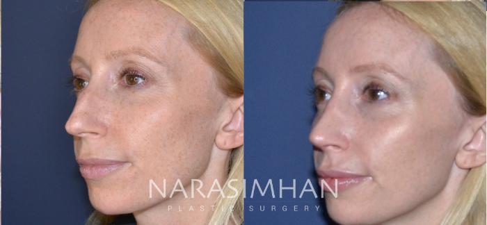 Before & After Rhinoplasty Case 167 View #3 View in Tampa, Florida