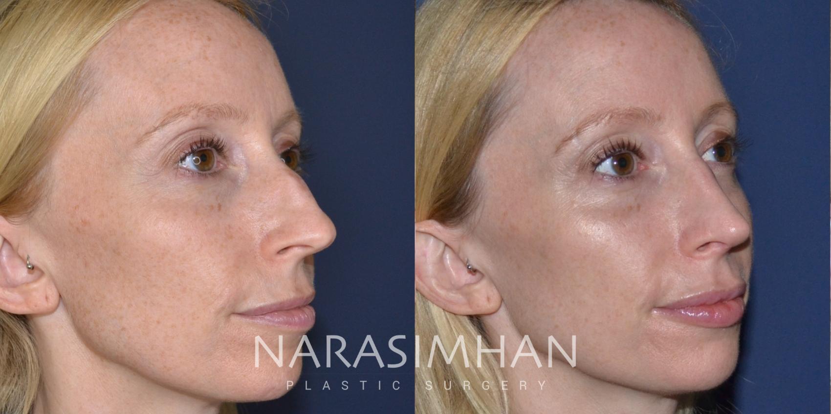 Before & After Rhinoplasty Case 167 View #4 View in St Petersburg, Florida