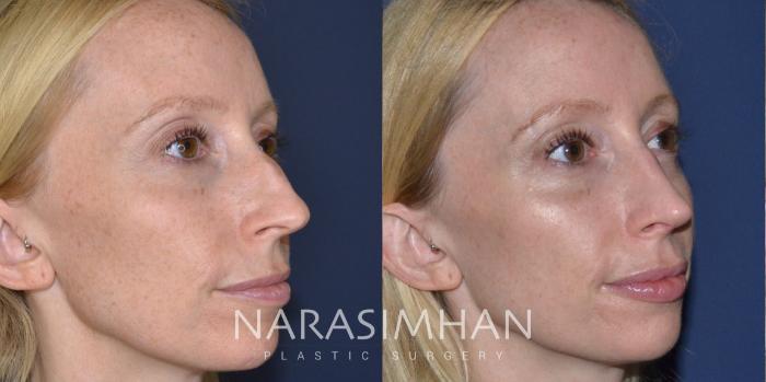 Before & After Rhinoplasty Case 167 View #4 View in Tampa, Florida