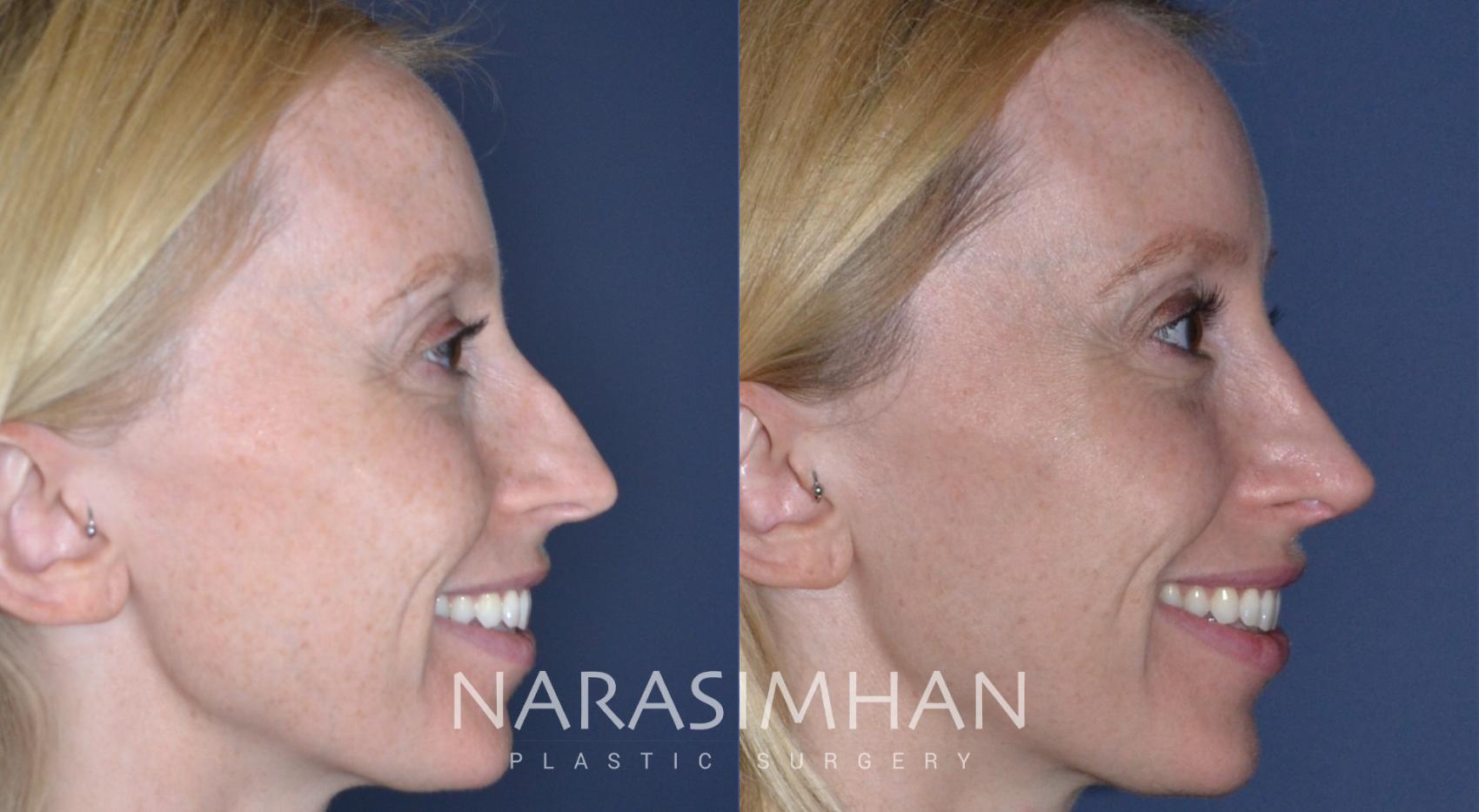 Before & After Rhinoplasty Case 167 View #5 View in St. Petersburg, Florida