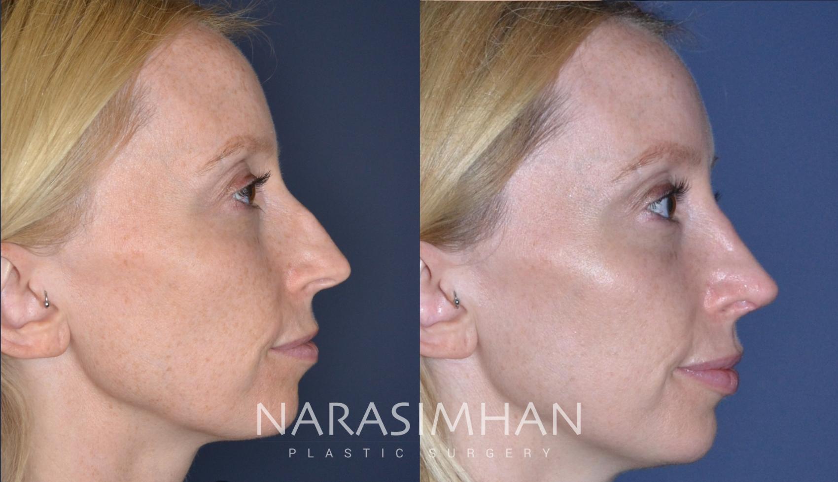 Before & After Rhinoplasty Case 167 View #6 View in St. Petersburg, Florida
