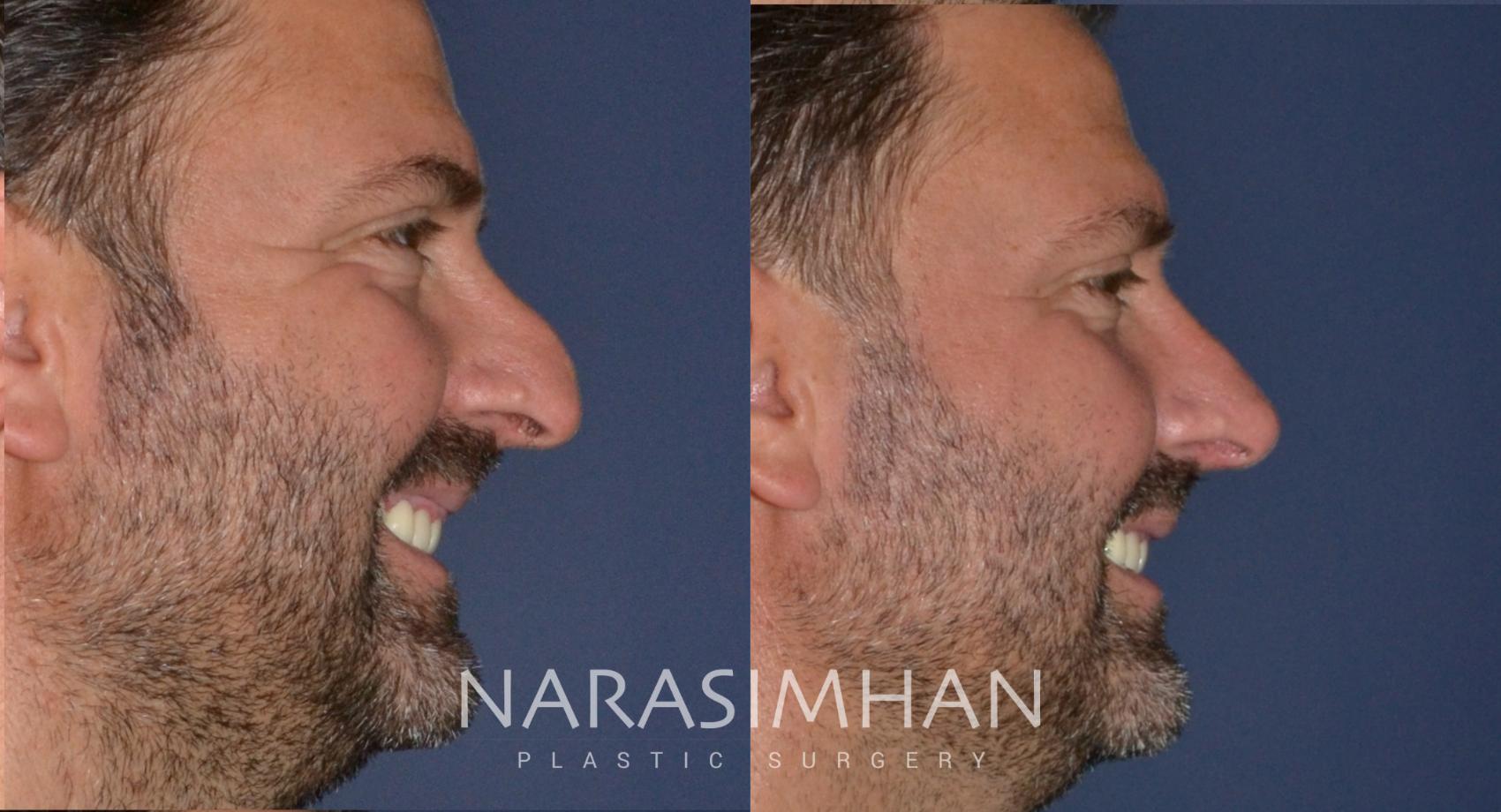 Before & After Rhinoplasty Case 171 View #1 View in St Petersburg, Florida