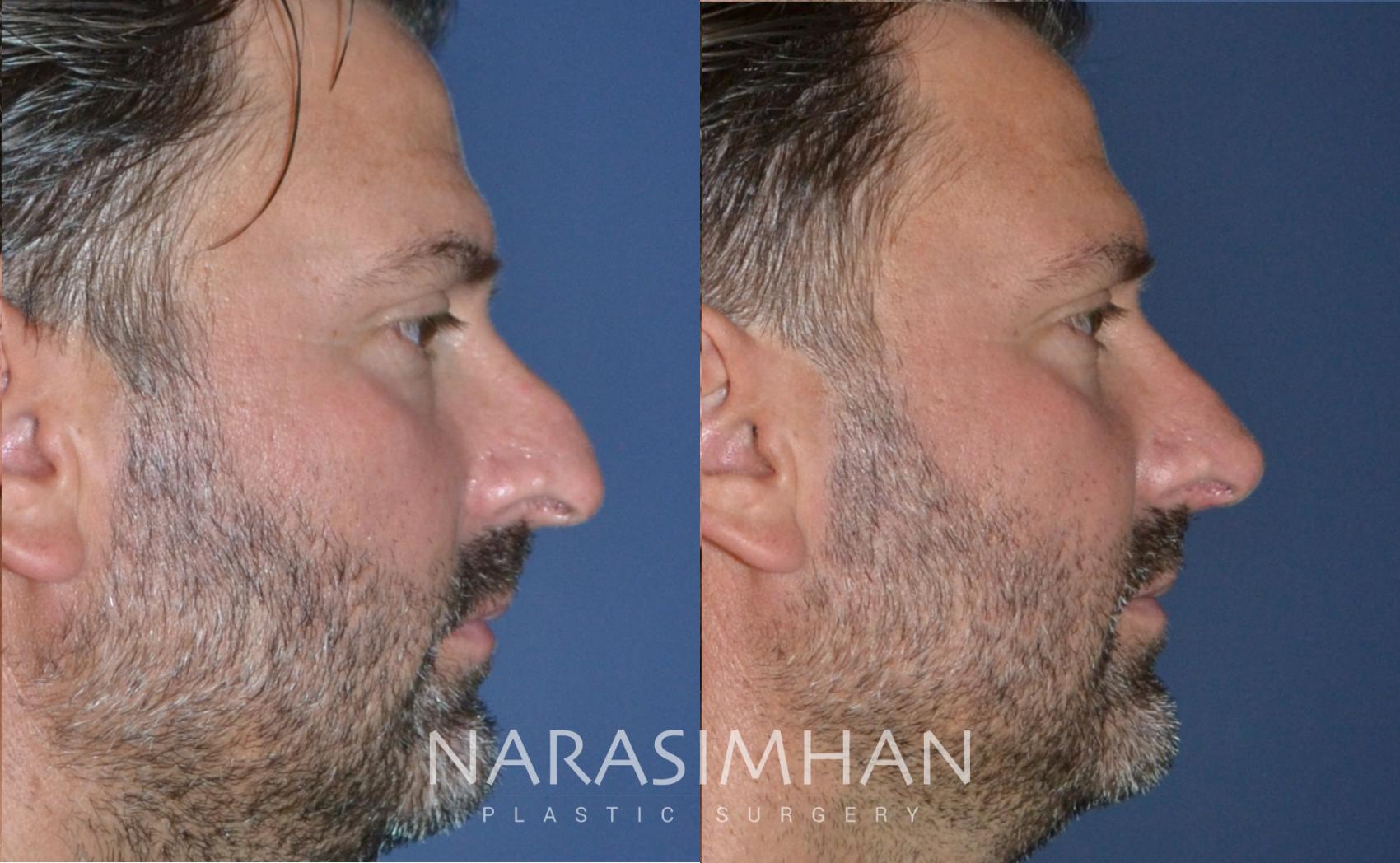Before & After Rhinoplasty Case 171 View #2 View in St Petersburg, Florida