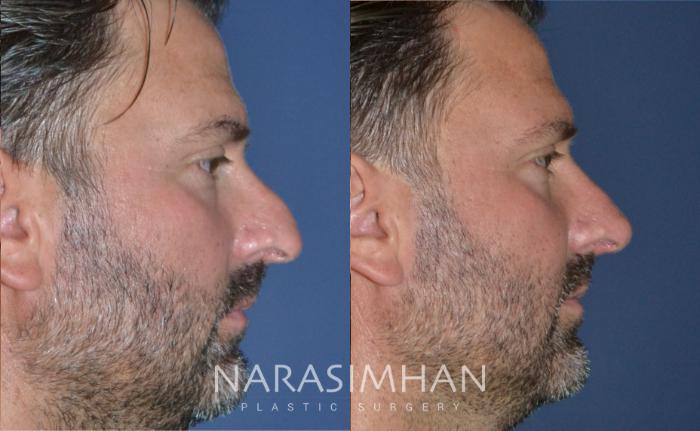 Before & After Rhinoplasty Case 171 View #2 View in Tampa, Florida
