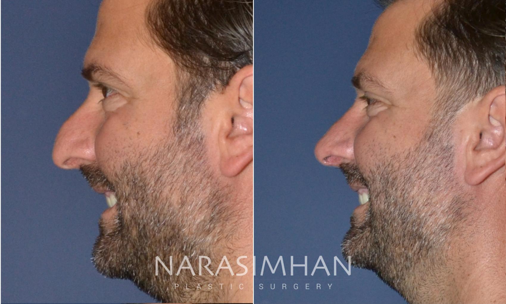 Before & After Rhinoplasty Case 171 View #3 View in St Petersburg, Florida