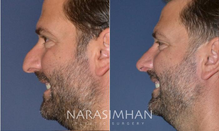 Before & After Rhinoplasty Case 171 View #3 View in Tampa, Florida