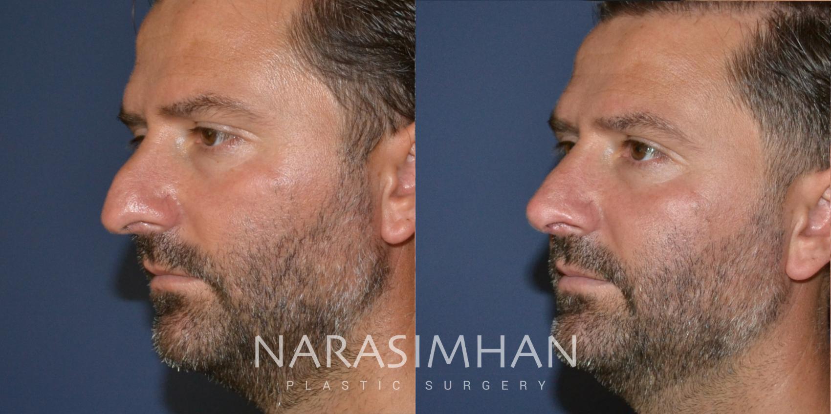 Before & After Rhinoplasty Case 171 View #4 View in St Petersburg, Florida