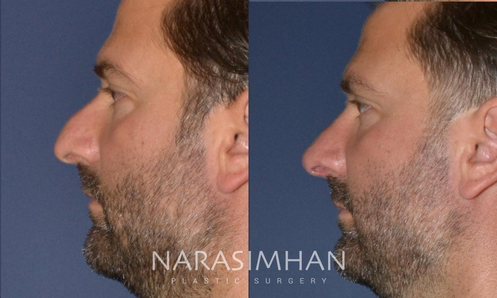 Before & After Rhinoplasty Case 171 View #5 View in St Petersburg, Florida