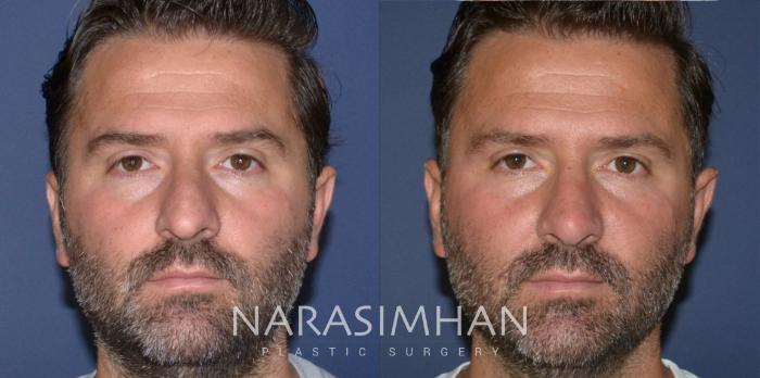 Before & After Rhinoplasty Case 171 View #6 View in Tampa, Florida
