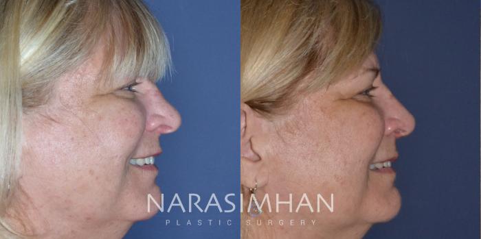 Before & After Rhinoplasty Case 173 View #1 View in Tampa, Florida