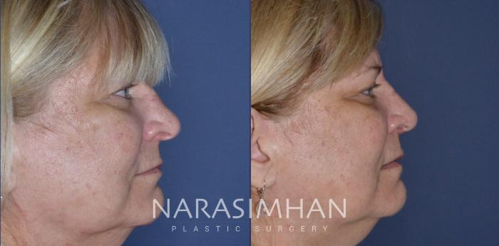 Before & After Rhinoplasty Case 173 View #2 View in Tampa, Florida