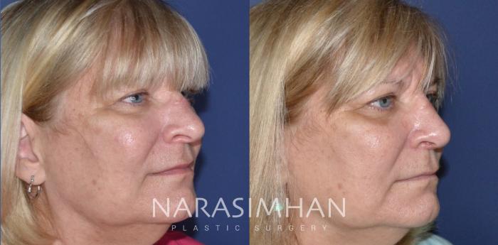 Before & After Rhinoplasty Case 173 View #3 View in Tampa, Florida