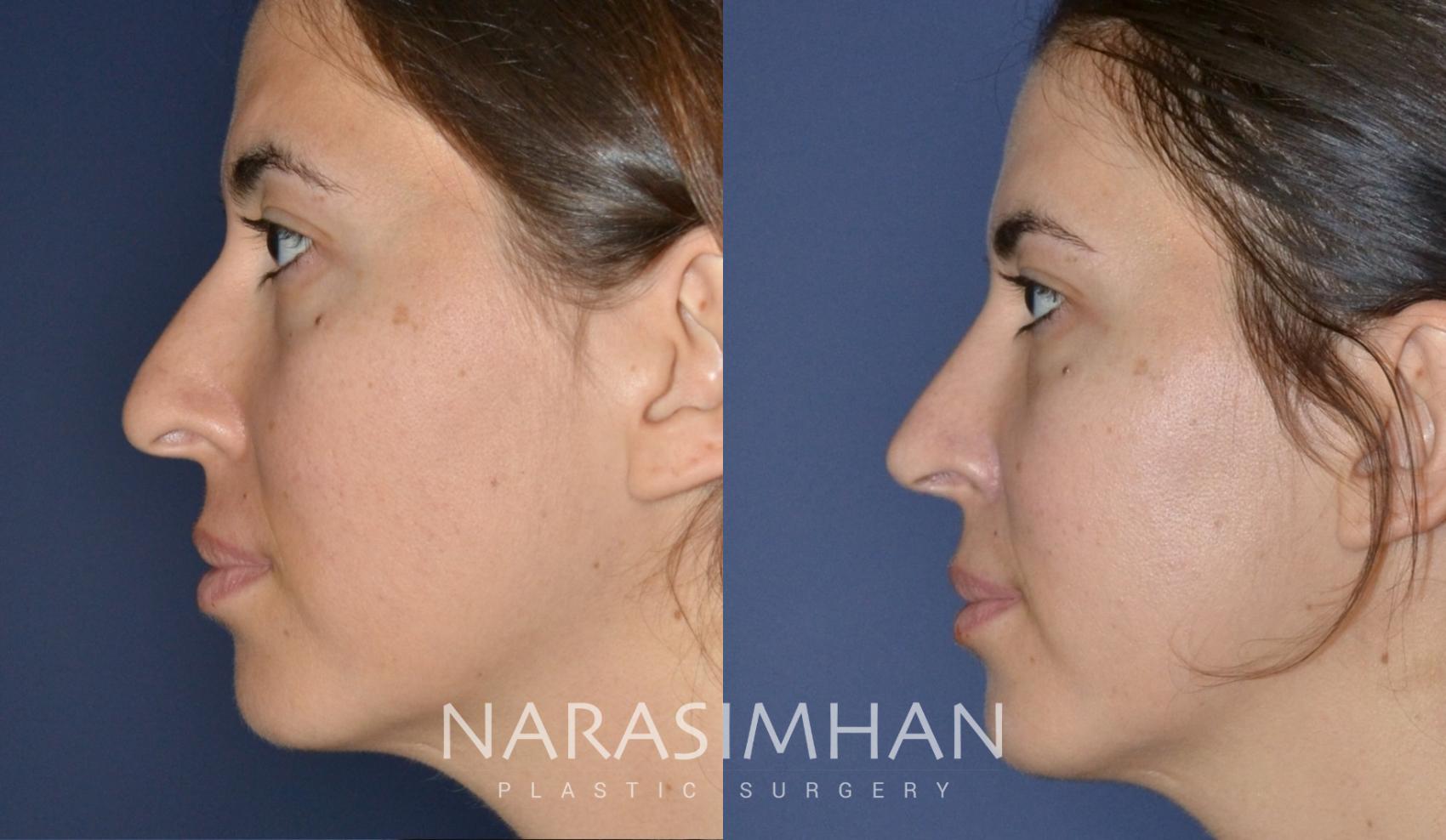 Before & After Ethnic Rhinoplasty Case 174 View #1 View in Tampa, Florida