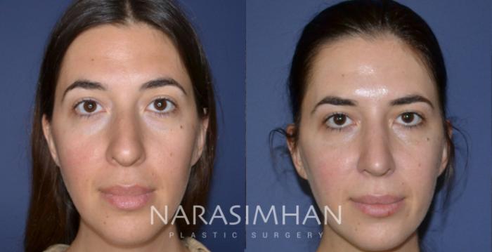 Before & After Ethnic Rhinoplasty Case 174 View #2 View in Tampa, Florida