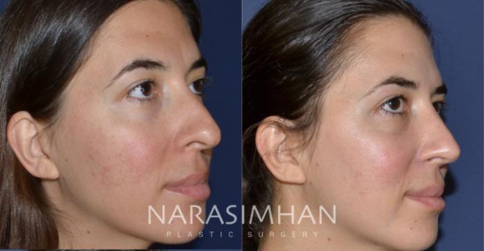 Before & After Rhinoplasty Case 174 View #3 View in Tampa, Florida