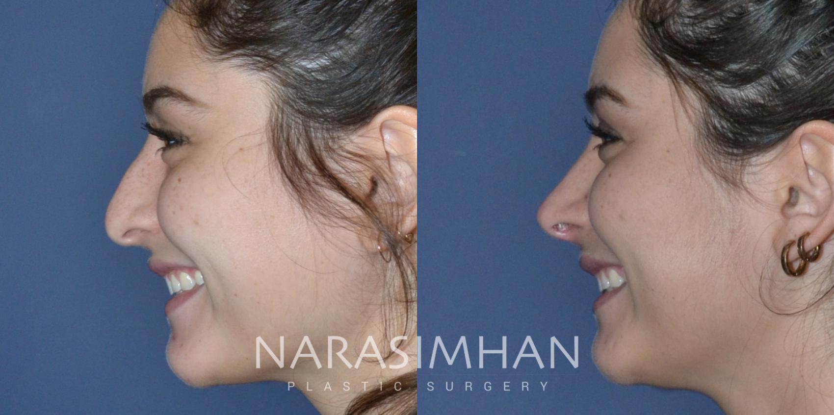 Before & After Rhinoplasty Case 175 View #1 View in St Petersburg, Florida