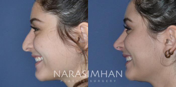 Before & After Rhinoplasty Case 175 View #1 View in Tampa, Florida