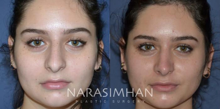 Before & After Rhinoplasty Case 175 View #2 View in Tampa, Florida