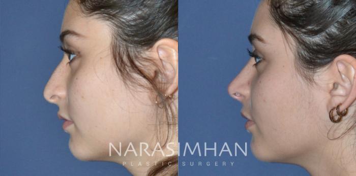 Before & After Rhinoplasty Case 175 View #3 View in Tampa, Florida