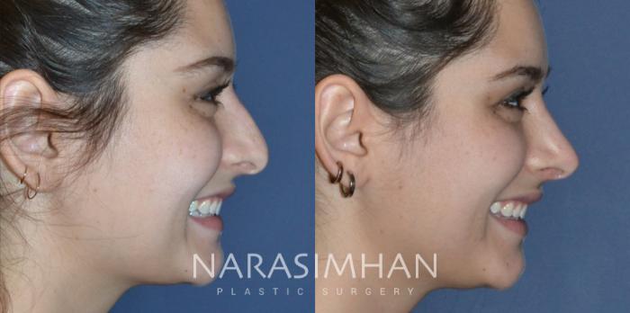 Before & After Rhinoplasty Case 175 View #4 View in Tampa, Florida