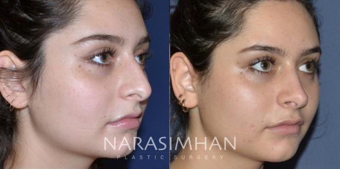 Before & After Rhinoplasty Case 175 View #5 View in Tampa, Florida