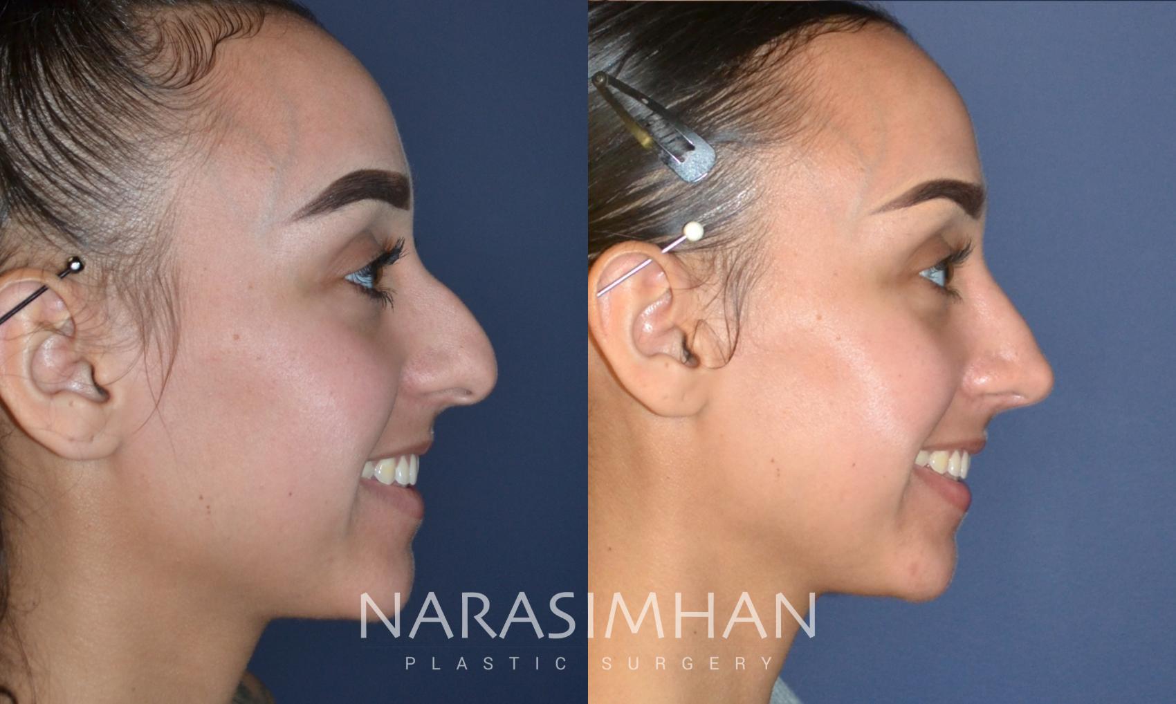 Before & After Rhinoplasty Case 176 View #1 View in St Petersburg, Florida