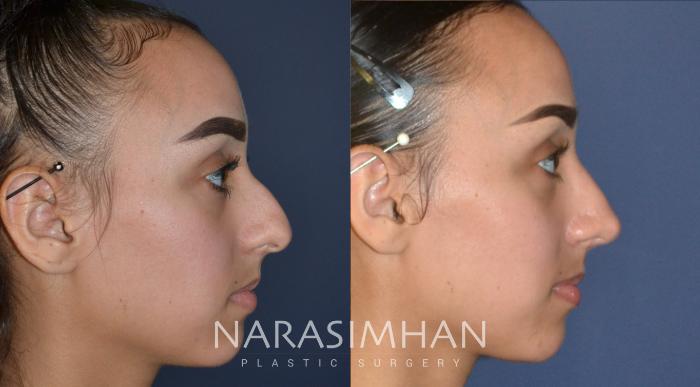 Before & After Rhinoplasty Case 176 View #2 View in Tampa, Florida