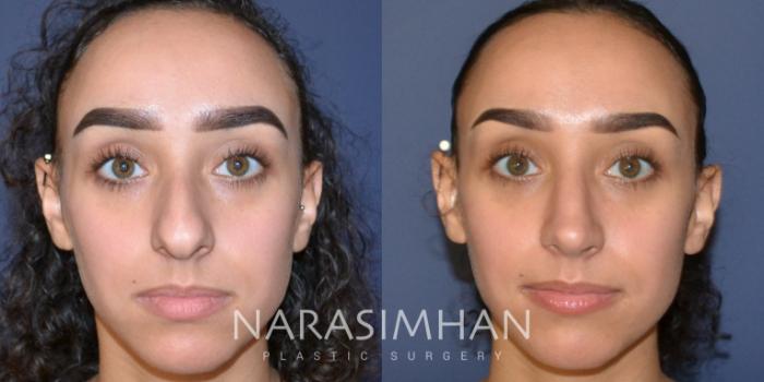 Before & After Rhinoplasty Case 176 View #3 View in Tampa, Florida