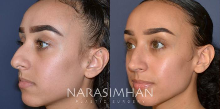 Before & After Rhinoplasty Case 176 View #4 View in Tampa, Florida