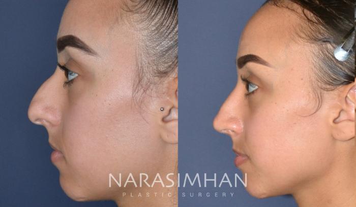 Before & After Rhinoplasty Case 176 View #5 View in Tampa, Florida