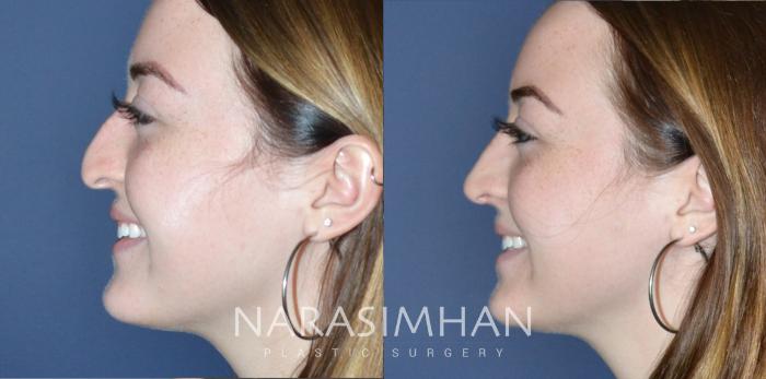 Before & After Rhinoplasty Case 181 View #1 View in Tampa, Florida
