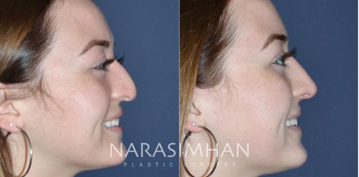 Before & After Rhinoplasty Case 181 View #3 View in Tampa, Florida