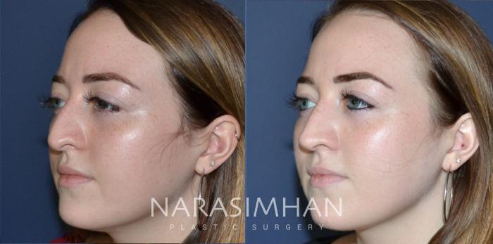 Before & After Rhinoplasty Case 181 View #4 View in Tampa, Florida