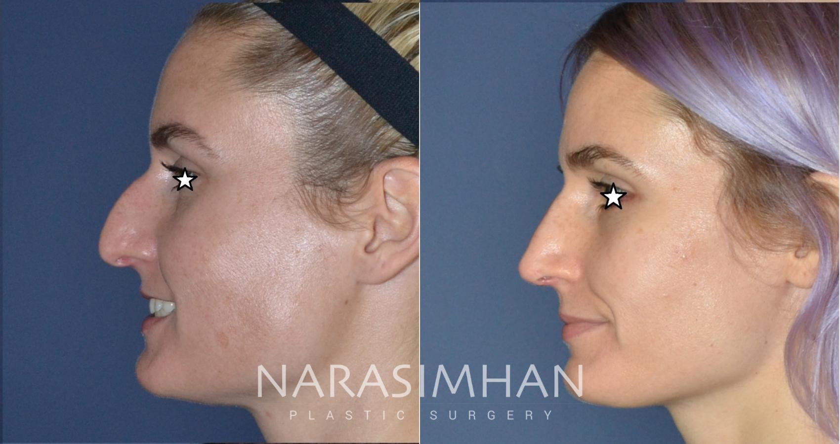 Before & After Rhinoplasty Case 182 View #1 View in Tampa, Florida