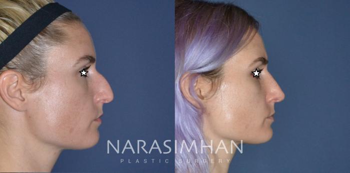 Before & After Rhinoplasty Case 182 View #2 View in Tampa, Florida