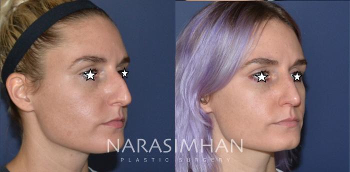Before & After Rhinoplasty Case 182 View #3 View in Tampa, Florida