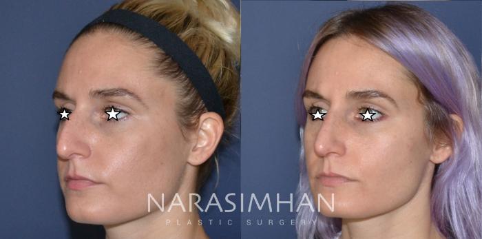 Before & After Rhinoplasty Case 182 View #4 View in Tampa, Florida
