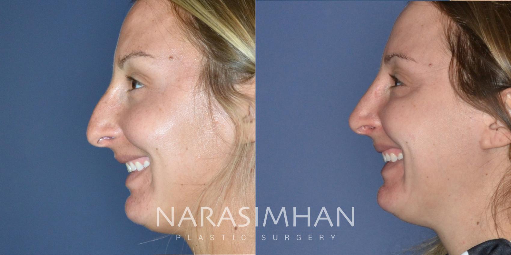 Before & After Rhinoplasty Case 189 View #1 View in St Petersburg, Florida