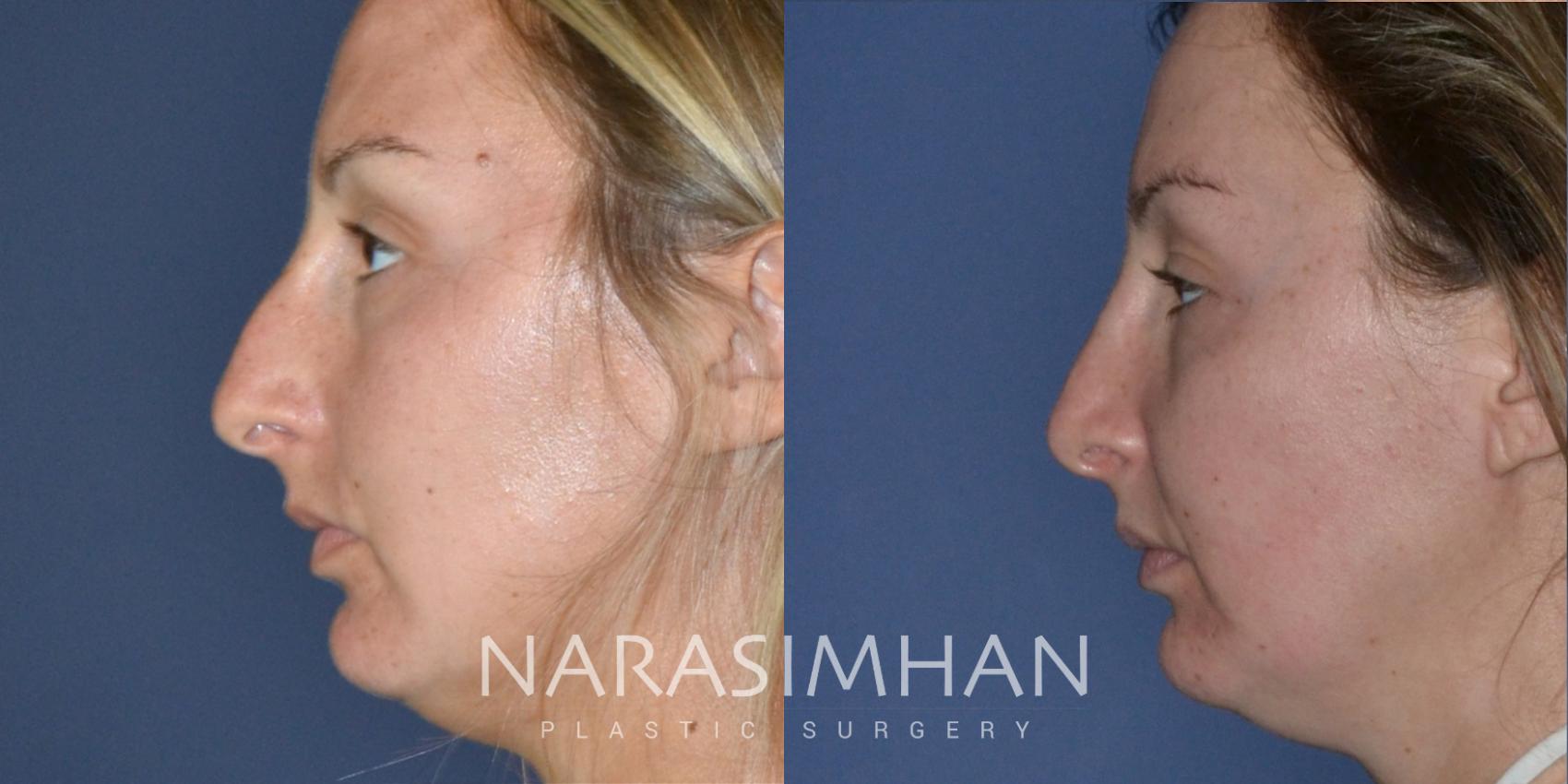 Before & After Rhinoplasty Case 189 View #2 View in St Petersburg, Florida