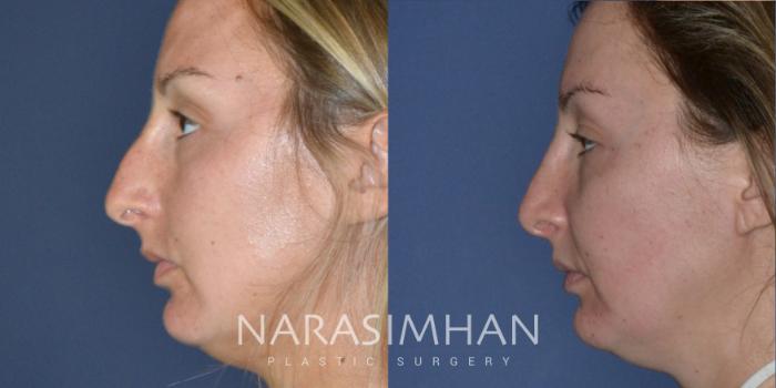 Before & After Rhinoplasty Case 189 View #2 View in Tampa, Florida