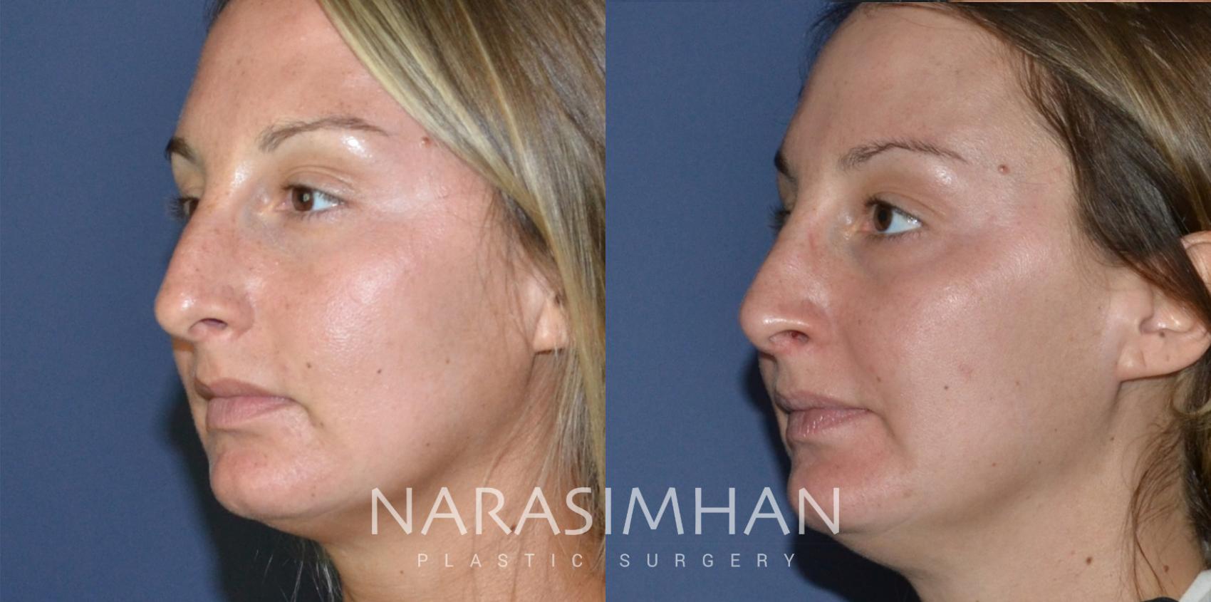 Before & After Rhinoplasty Case 189 View #3 View in St Petersburg, Florida