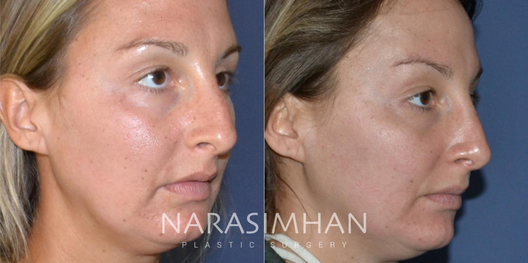 Before & After Rhinoplasty Case 189 View #4 View in St Petersburg, Florida