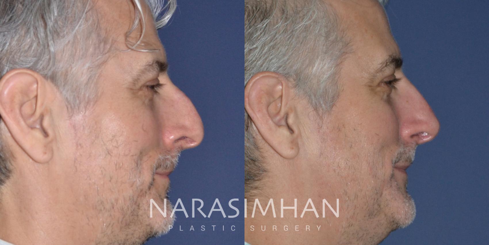 Before & After Rhinoplasty Case 190 View #1 View in St Petersburg, Florida
