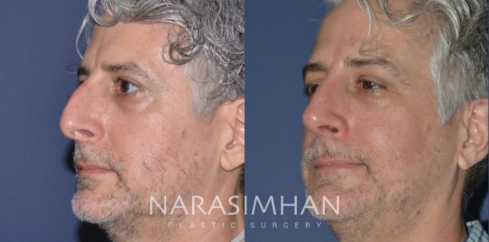 Before & After Rhinoplasty Case 190 View #2 View in St Petersburg, Florida