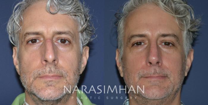 Before & After Rhinoplasty Case 190 View #3 View in St Petersburg, Florida