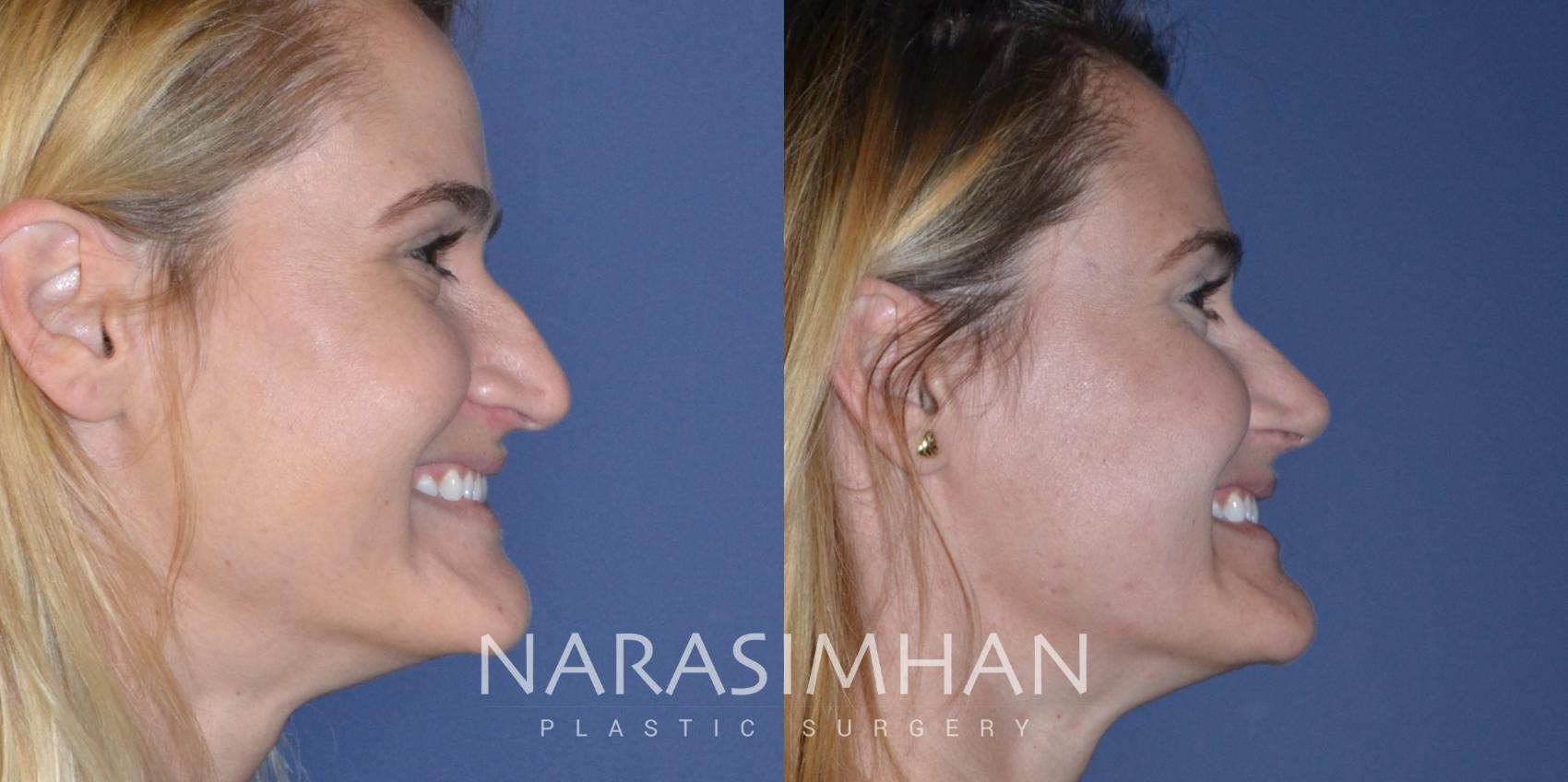 Before & After Rhinoplasty Case 201 View #1 View in Tampa, Florida